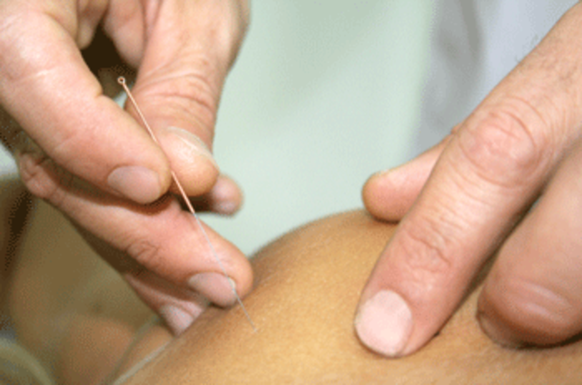 acupuncture Charley James Returns: Now, What Was I Saying ... ?