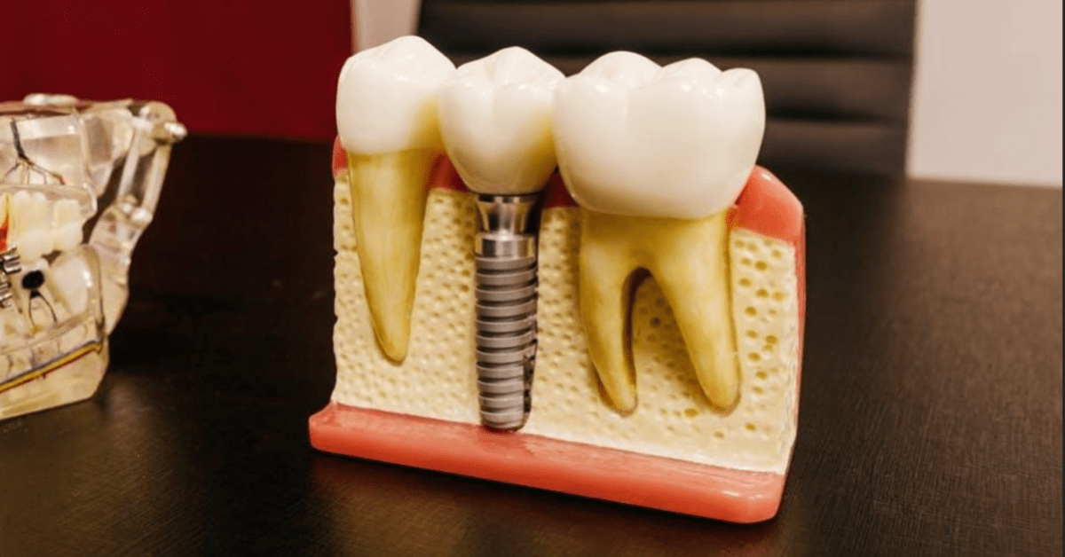 Different Types of Dental Implants: A Comprehensive Guide - LA Progressive