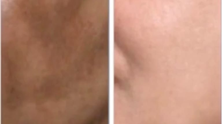 Dr. Simon Ourian Giving Hope to Melasma Patients Worldwide