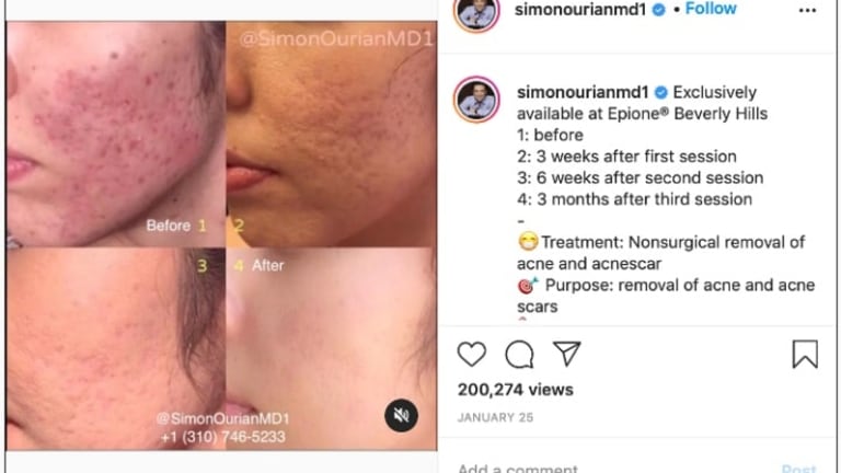 Dr. Simon Ourian Addresses Acne Scars with Coolaser