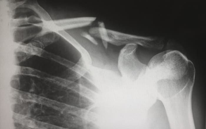 personal injury claim
