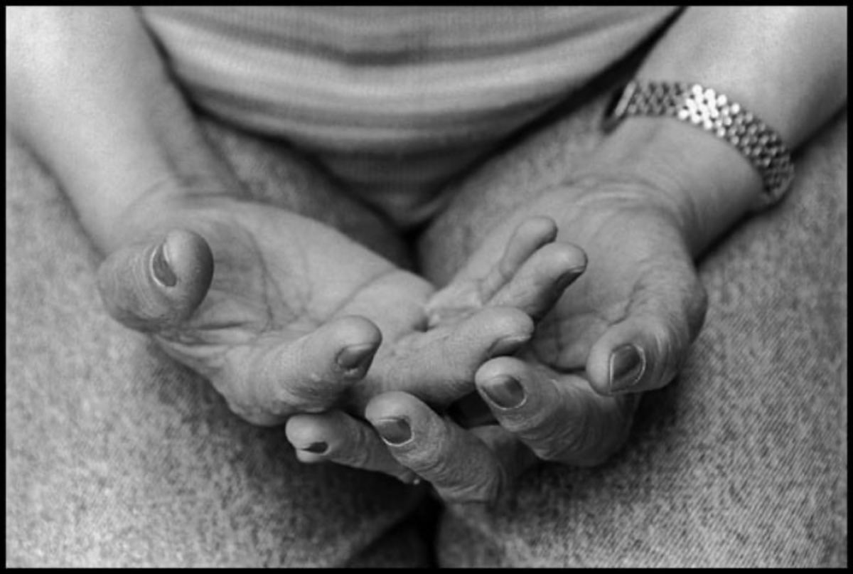 The hands of a hotel housekeeper. This is one of several photographs taken during union contract negotiations in 1999, to show hotel operators that making beds with the new thick mattresses took a toll on the hands and bodies of workers.