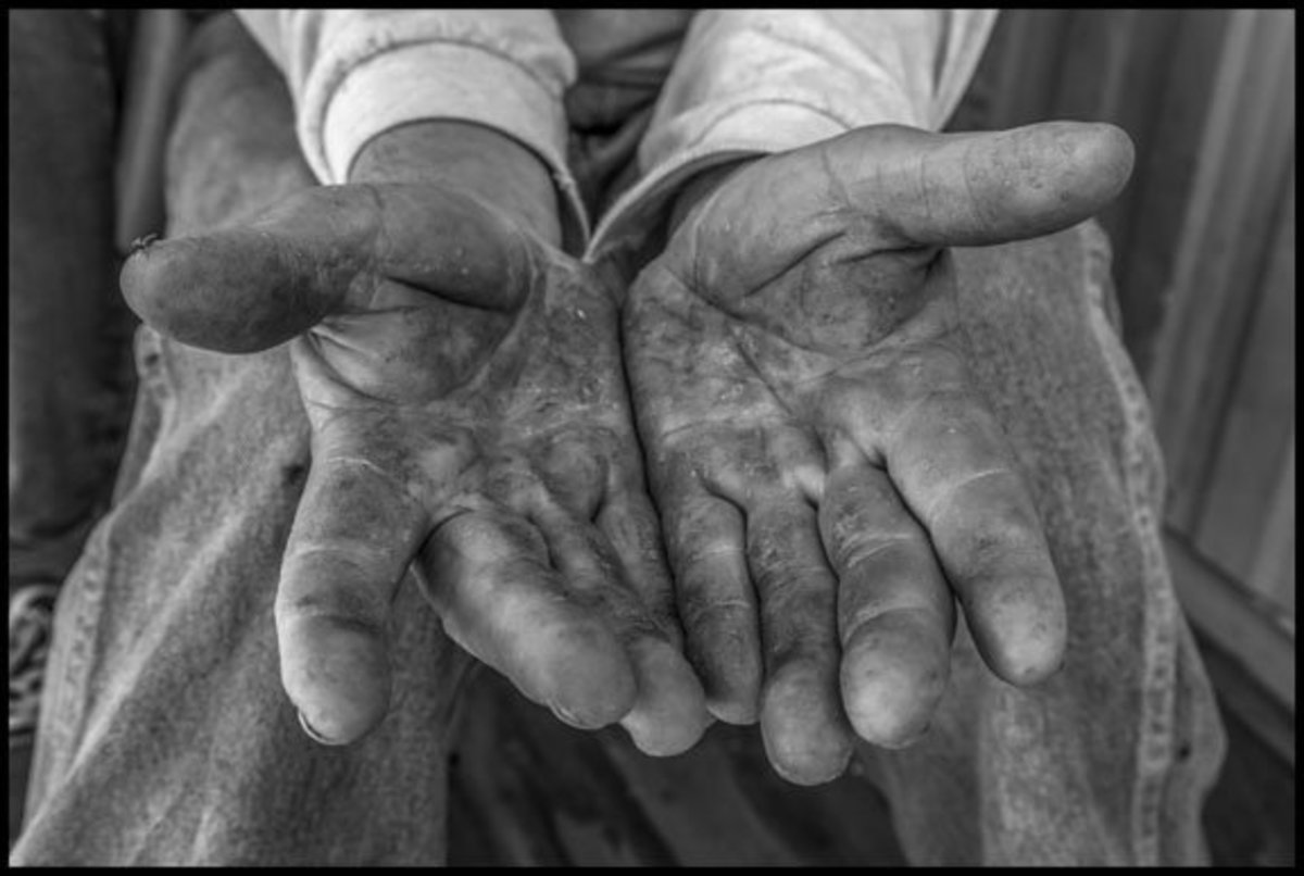 COACHELLA VALLEY, CA - 3APRIL17 - Carlos Chavez works as a palmero, in the date palm groves of Coachella Valley, and has worked over 20 years in the trees.  His hands show the lines and creases of a lifetime of hard work in the trees.Copyright David Bacon